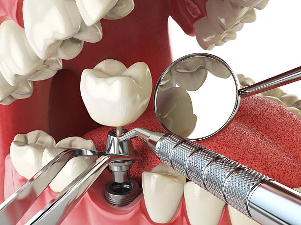 Best Emergency Denture Repair in Vaughn, WA